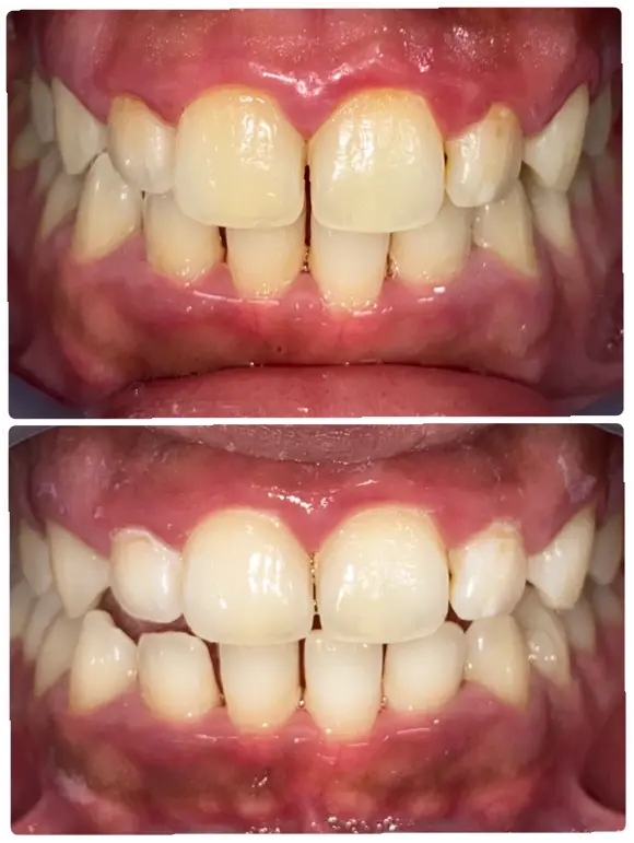 ホワイトニングの before after画像