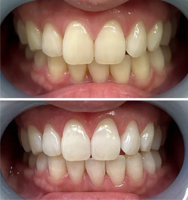 ホワイトニングの before after画像