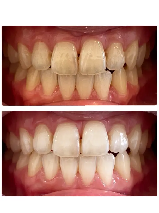 ホワイトニングの before after画像