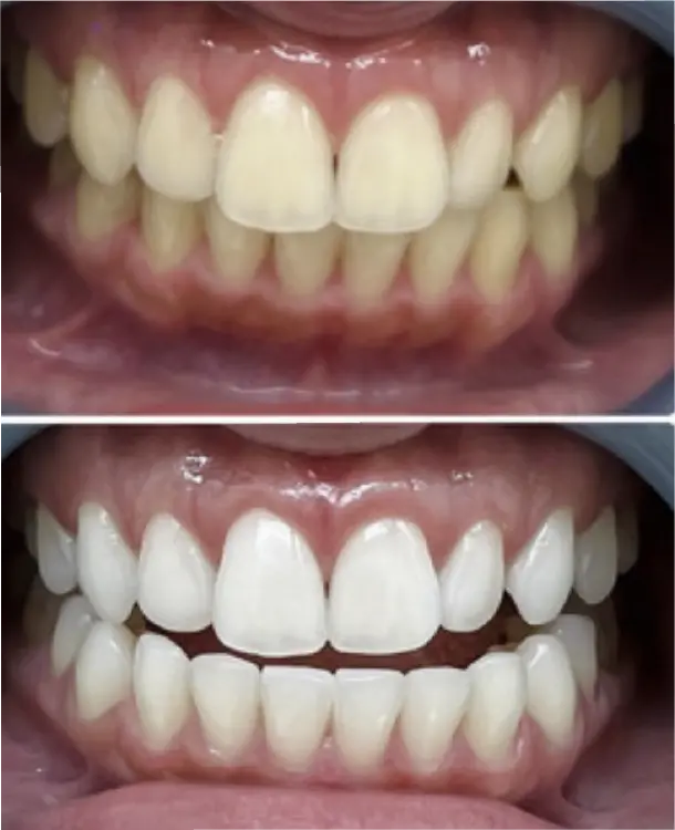 ホワイトニングの before after画像