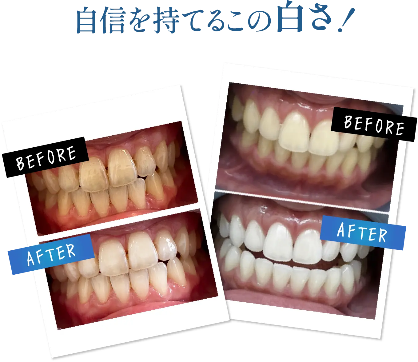 自信を持てるこの白さ！ BEFORE AFTERの画像